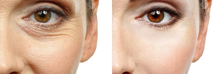 Considering an Anti-Aging/Facial Rejuvenation Procedure?